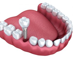 Canton Dentist Dental Implants